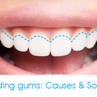 Smile with receding gums causes and solutions